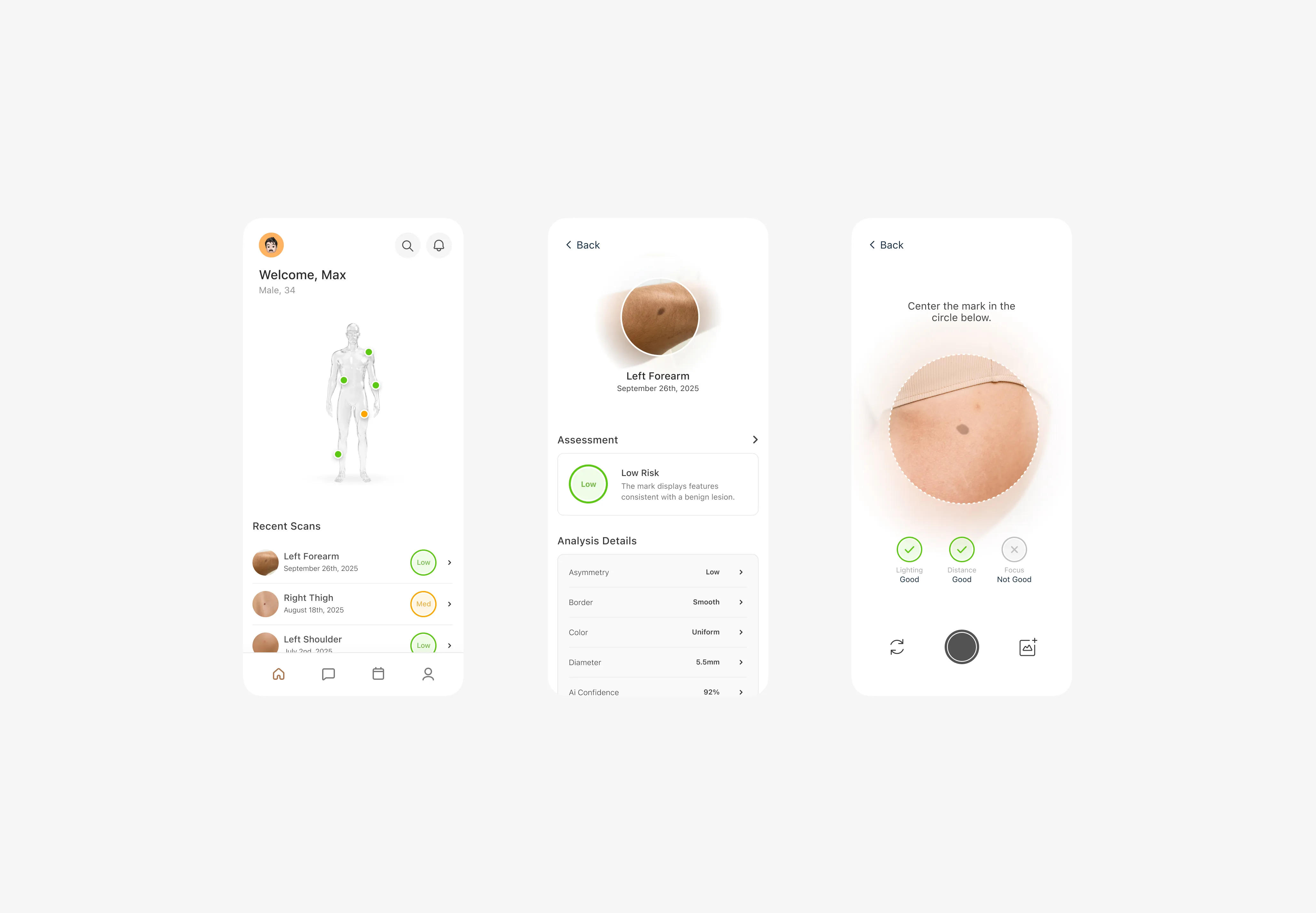 Three mobile app screens showing a skin lesion monitoring app with body scan map, lesion assessment details, and a close-up marking interface.